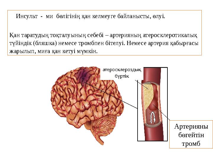 Инсульт - ми бөлігінің қан келмеуге байланысты, өлуі. Қан таратудың тоқталуының себебі – артерияның атеросклеротикалық түй