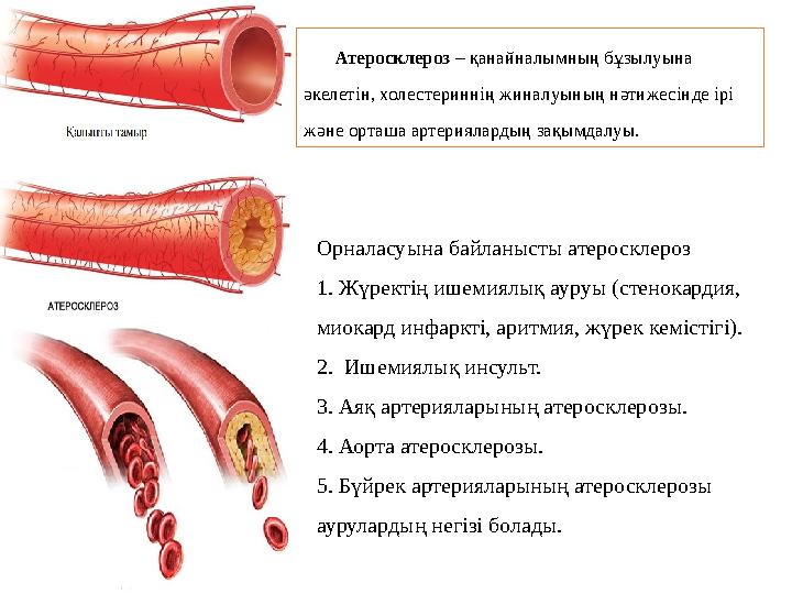 Атеросклероз – қанайналымның бұзылуына әкелетін, холестериннің жиналуының нәтижесінде ірі және орташа артериялардың зақымдалуы