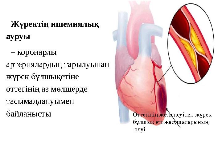 Жүректің ишемиялық ауруы – коронарлы артериялардың тарылуынан жүрек бұлшықетіне оттегінің аз мөлшерде тасымалдануымен байл