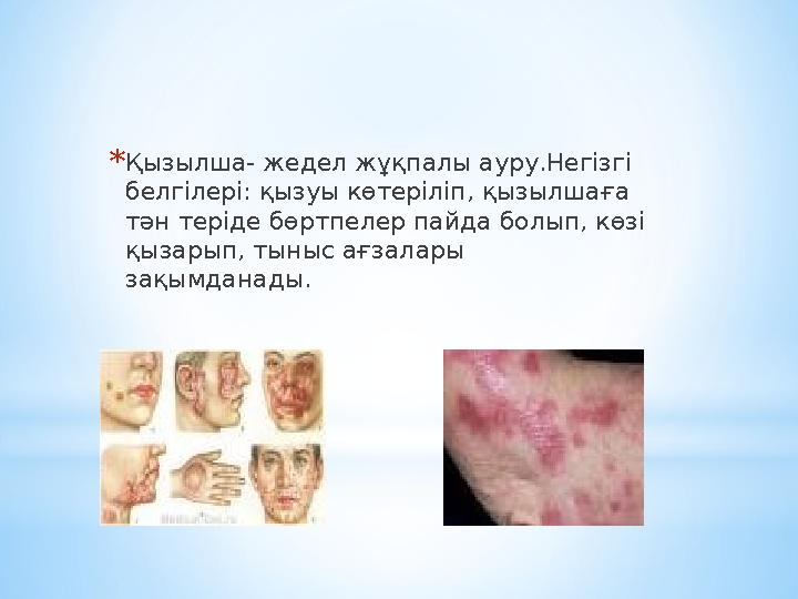 *Қызылша- жедел жұқпалы ауру.Негізгі белгілері: қызуы көтеріліп, қызылшаға тән теріде бөртпелер пайда болып, көзі қызарып, ты