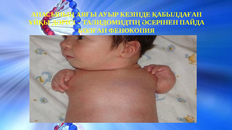 АНАСЫНЫҢ АЯҒЫ АУЫР КЕЗІНДЕ ҚАБЫЛДАҒАН ҰЙҚЫ ДӘРІСІ – ТАЛИДОМИДТІҢ ӘСЕРІНЕН ПАЙДА БОЛҒАН ФЕНОКОПИЯ