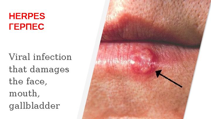HERPES ГЕРПЕС Viral infection that damages the face, mouth, gallbladder