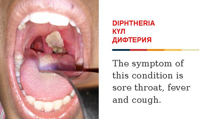 DIPHTHERIA КҮЛ ДИФТЕРИЯ The symptom of this condition is sore throat, fever and cough.