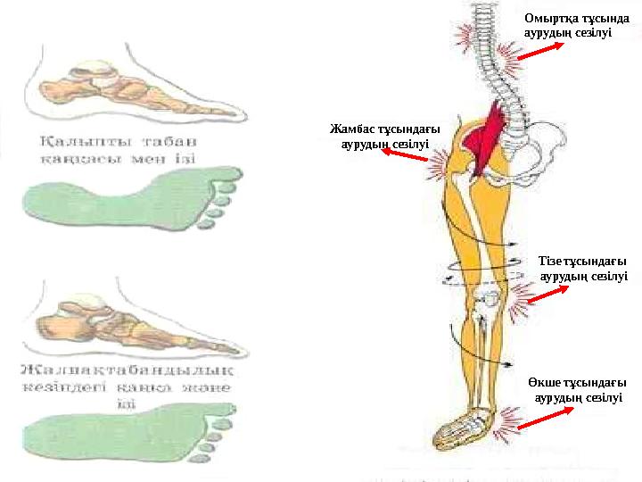 Омыртқа тұсында аурудың сезілуі Жамбас тұсындағы аурудың сезілуі Тізе тұсындағы аурудың сезілуі Өкше тұсындағы аурудың сезілуі
