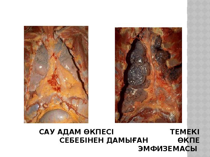 САУ АДАМ ӨКПЕСІ ТЕМЕКІ СЕБЕБІНЕН ДАМЫҒАН ӨКПЕ ЭМФИЗЕМАСЫ