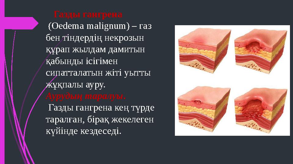 Газды гангрена (Oedema malignum) – газ бен тіндердің некрозын құрап жылдам дамитын қабынды ісігімен сипатталатын жіті уытты