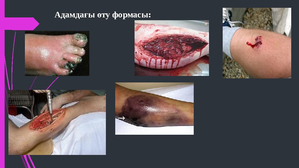 Адамдағы өту формасы: