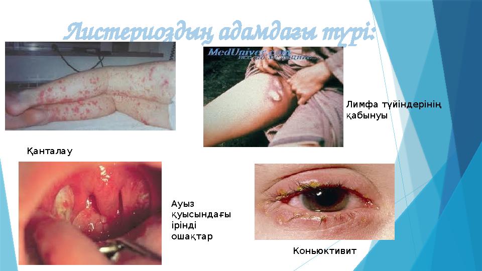 Листериоздың адамдағы түрі: Қанталау Лимфа түйіндерінің қабынуы КоньюктивитАуыз қуысындағы ірінді ошақтар
