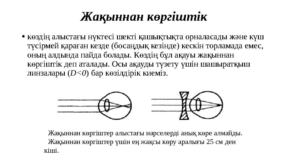 Жақыннан көргіштік • көздің алыстағы нүктесі шекті қашықтықта орналасады және күш түсірмей қараған кезде (босаңдық кезінде) кес