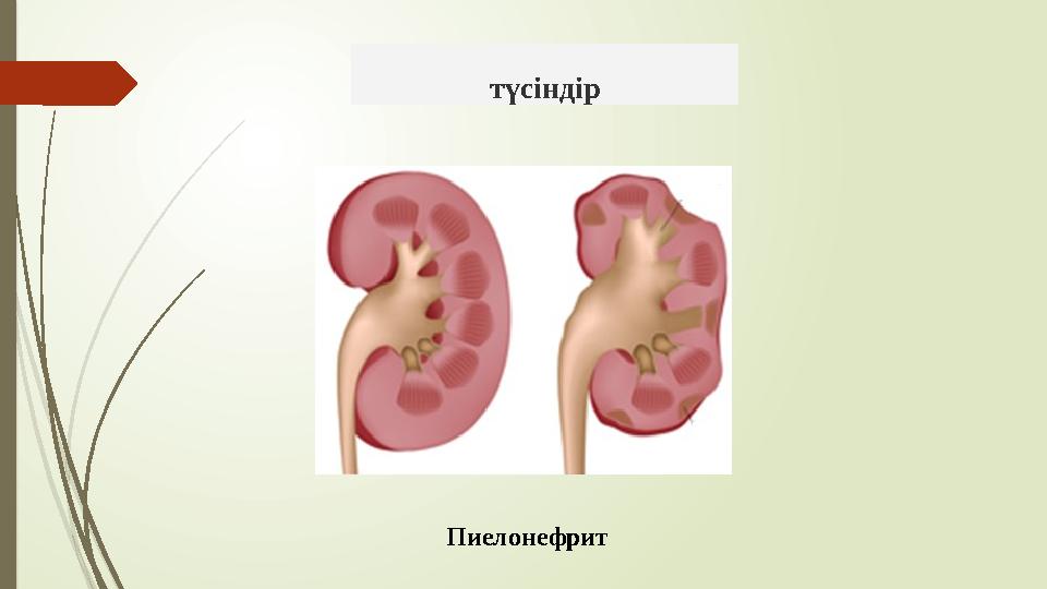 түсіндір Пиелонефрит
