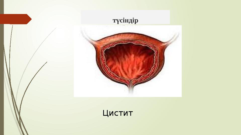 түсіндір Цистит