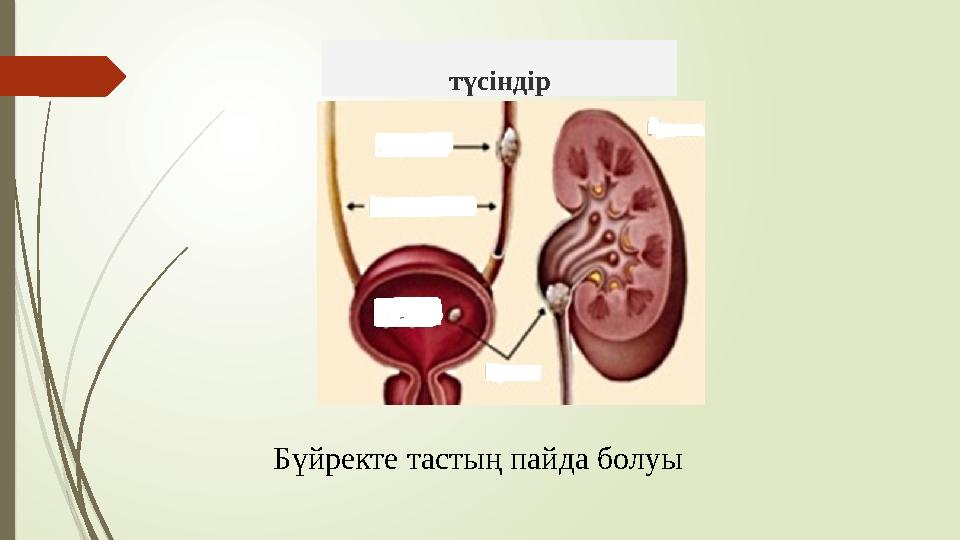 түсіндір Бүйректе тастың пайда болуы