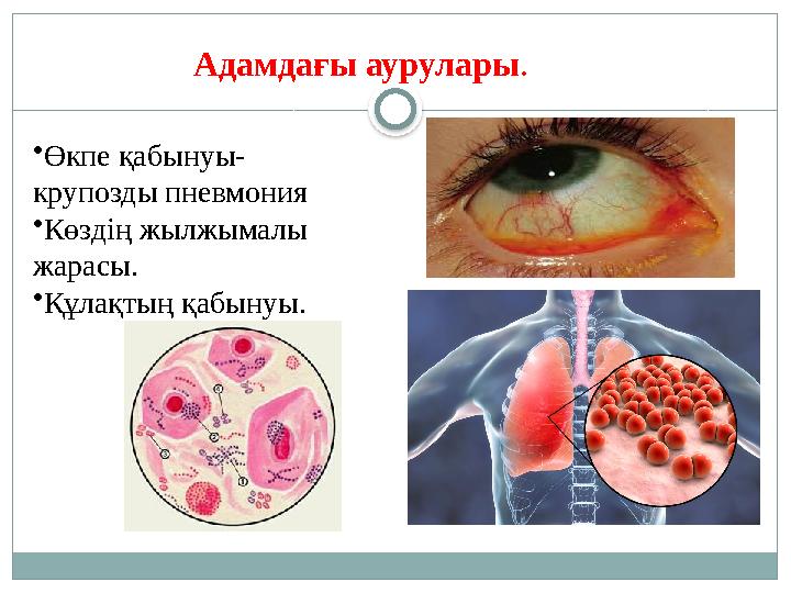 • Өкпе қабынуы- крупозды пневмония • Көздің жылжымалы жарасы. • Құлақтың қабынуы. Адамдағы аурулары .