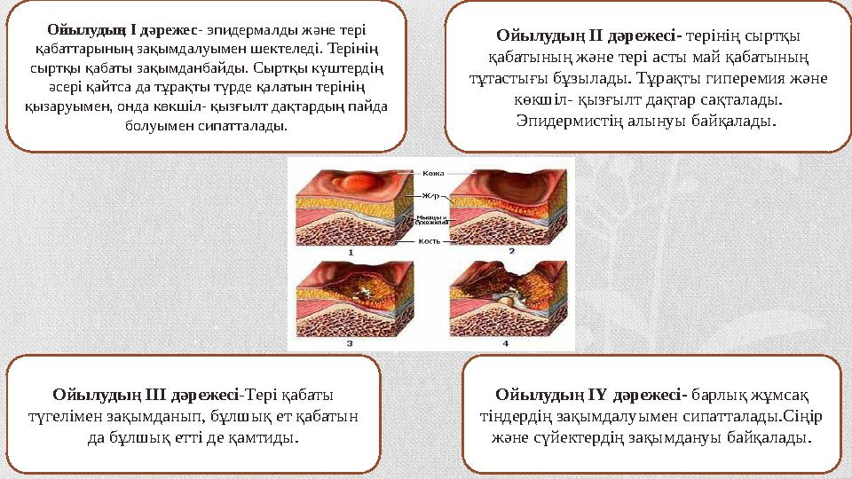 Ойылудың І дәрежес - эпидермалды және тері қабаттарының зақымдалуымен шектеледі. Терінің сыртқы қабаты зақымданбайды. Сыртқы к