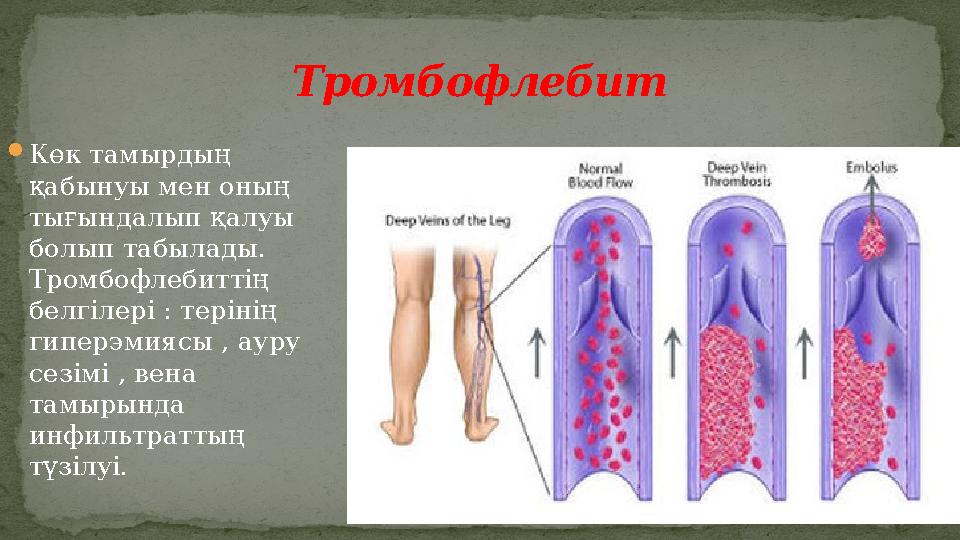  Көк тамырдың қабынуы мен оның тығындалып қалуы болып табылады. Тромбофлебиттің белгілері : терінің гиперэмиясы , ауру с