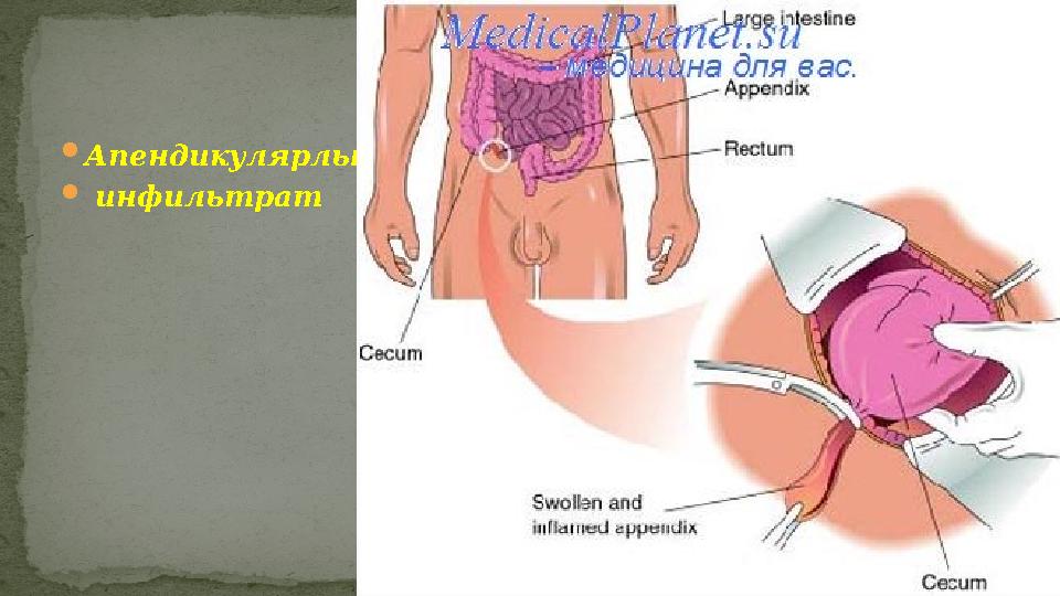  Апендикулярлы  инфильтрат