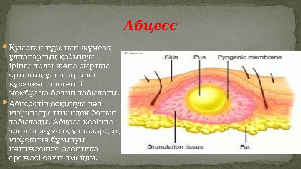  Қуыстан тұратын жұмсақ ұлпалардың қабынуы , іріңге толы және сыртқы ортаның ұлпаларынан құралған пиогенді мембрана болып