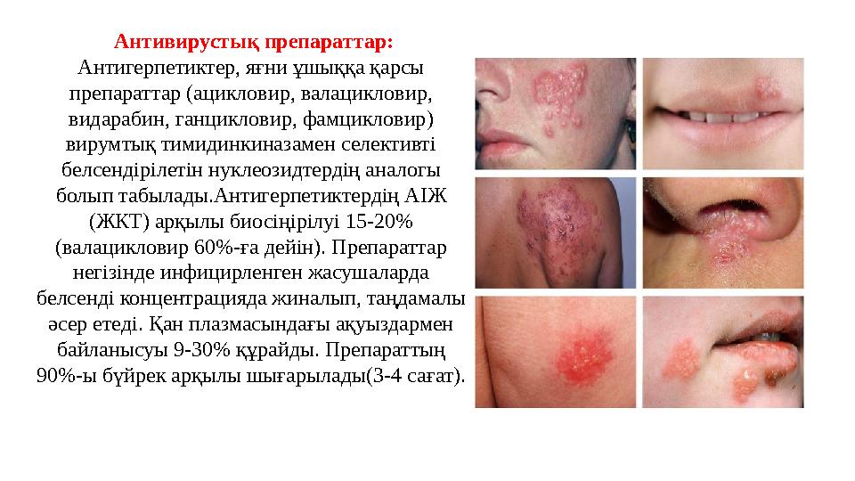 Антивирустық препараттар: Антигерпетиктер, яғни ұшыққа қарсы препараттар ( ацикловир, валацикловир, видарабин, ганцикловир,