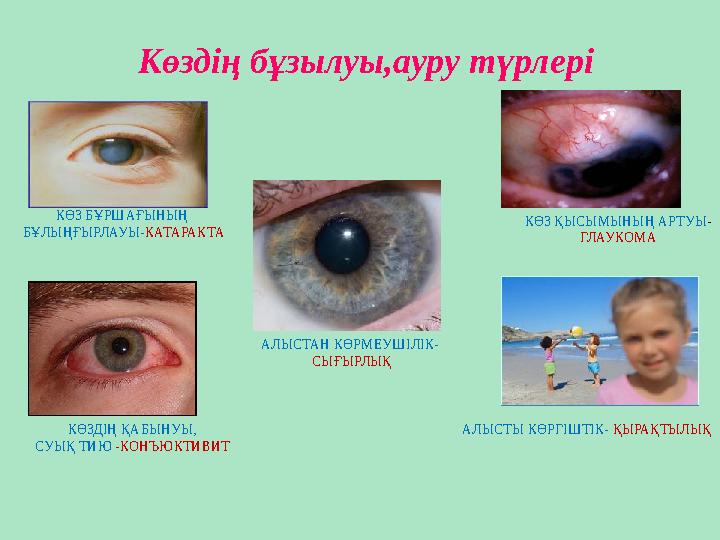 Көздің бұзылуы,ауру түрлері КӨЗ БҰРШАҒЫНЫҢ БҰЛЫҢҒЫРЛАУЫ- КАТАРАКТА КӨЗ ҚЫСЫМЫНЫҢ АРТУЫ - ГЛАУКОМА КӨЗДІҢ ҚАБЫНУЫ, СУЫҚ ТИЮ -КО