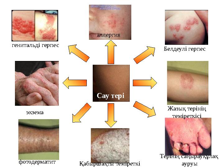 Сау теріаллергия Белдеулі герпес Жазық терінің теміреткісі Терінің саңырауқұлақ ауруы Қабыршақты теміреткігенитальді герпес фот
