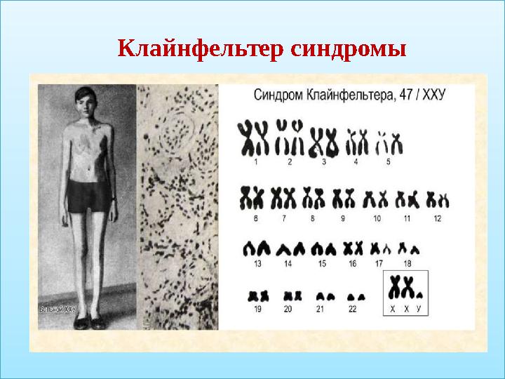 Клайнфельтер синдромы