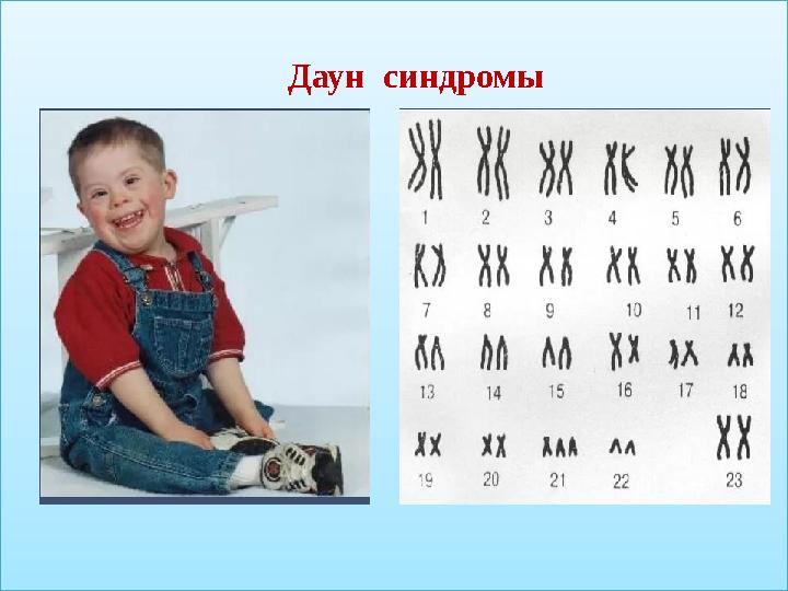 Даун синдромы