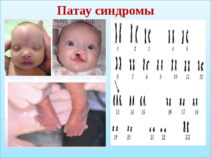 Патау синдромы