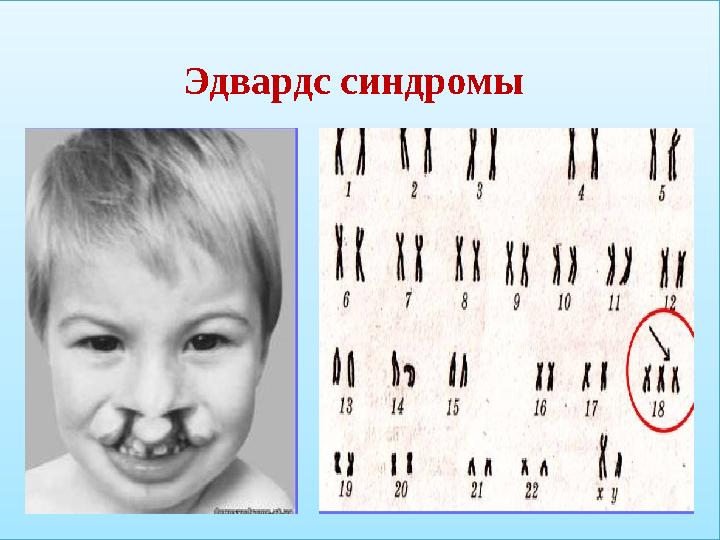 Эдвардс синдромы
