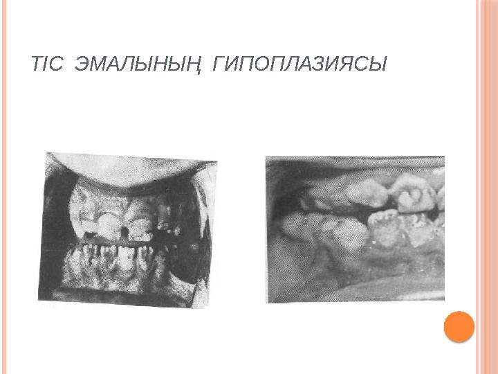 ТІС ЭМАЛЫНЫҢ ГИПОПЛАЗИЯСЫ