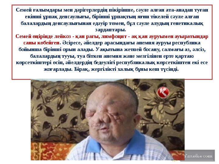 Семей ғалымдары мен дәрігерлердің пікірінше, сәуле алған ата-анадан туған екінші ұрпақ денсаулығы, бірінші ұрпақтың яғни тікеле