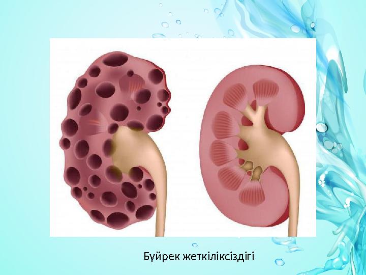 Бүйрек жеткіліксіздігі