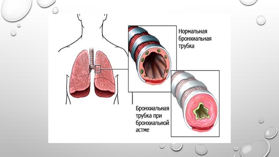 В инфильтрате стенки бронха при бронхиальной астме преобладают