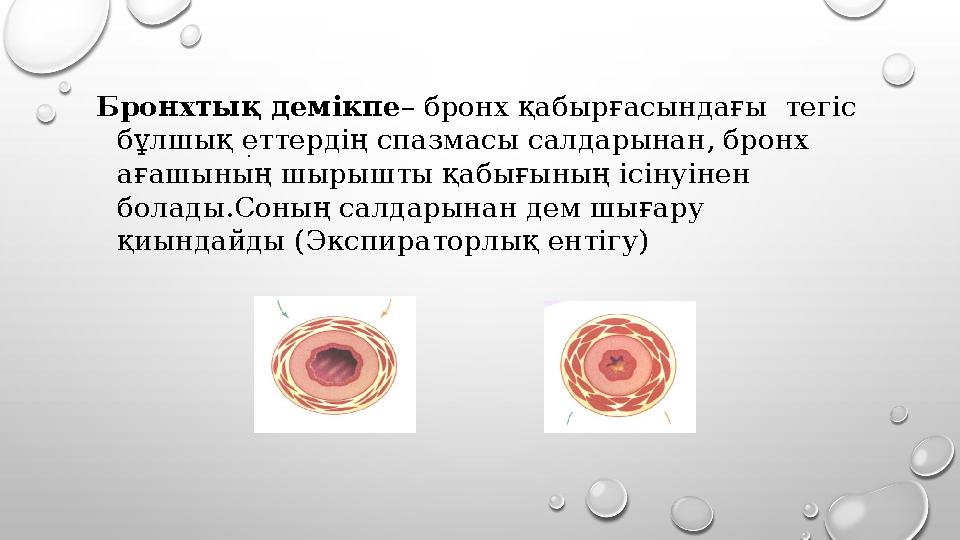 Бронхтық демікпе – бронх қабырғасындағы тегіс бұлшық еттердің спазмасы салдарынан, бронх ағашының шырышты қабығының ісінуіне