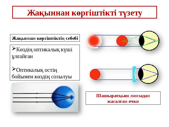 Жақыннан көргіштікті түзету Жақыннан көргіштіктің себебі  Көздің оптикалық күші ұлғайған  Оптикалық остің бойымен көздің соз