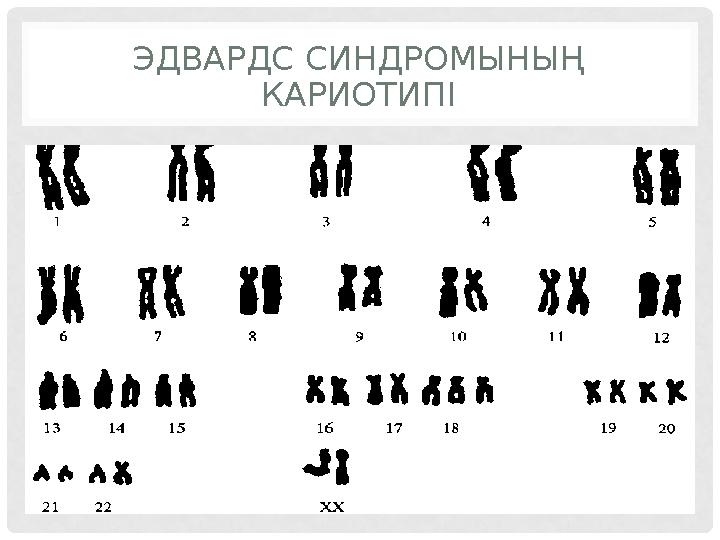 ЭДВАРДС СИНДРОМЫНЫҢ КАРИОТИПІ