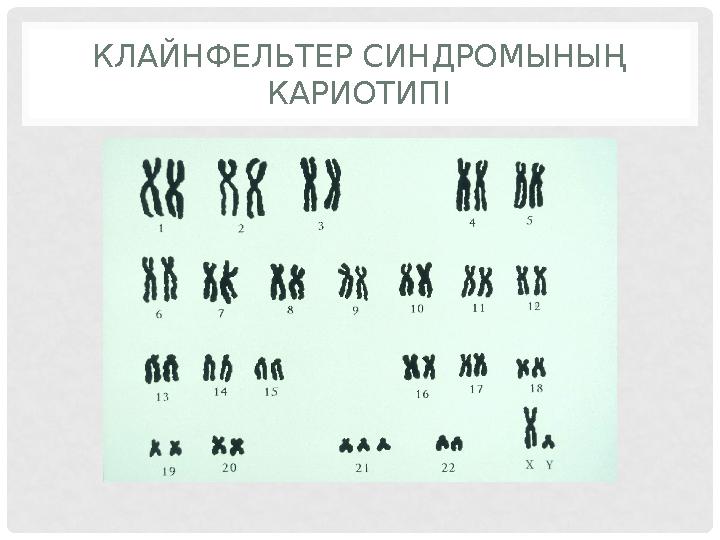 КЛАЙНФЕЛЬТЕР СИНДРОМЫНЫҢ КАРИОТИПІ