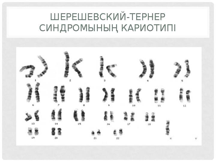 ШЕРЕШЕВСКИЙ-ТЕРНЕР СИНДРОМЫНЫҢ КАРИОТИПІ