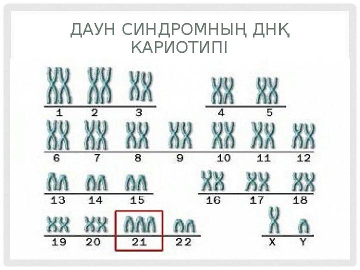 ДАУН СИНДРОМНЫҢ ДН Қ КАРИОТИПІ