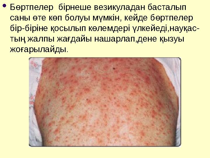  Бөртпелер бірнеше везикуладан басталып саны өте көп болуы мүмкін, кейде бөртпелер бір-біріне қосылып көлемдері үлкейеді,нау
