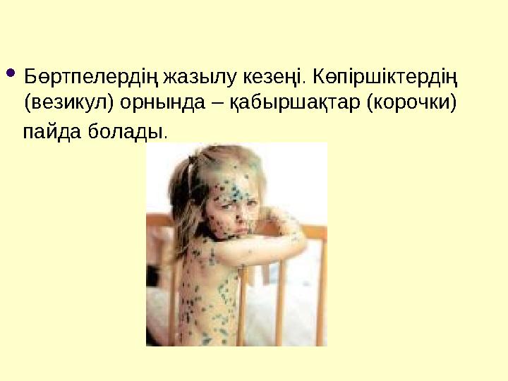  Бөртпелердің жазылу кезеңі. Көпіршіктердің (везикул) орнында – қабыршақтар (корочки) пайда болады.