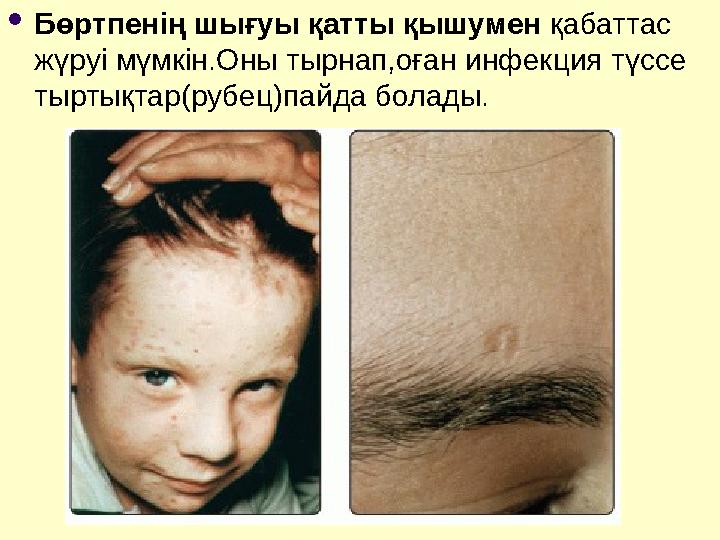  Бөртпенің шығуы қатты қышумен қабаттас жүруі мүмкін.Оны тырнап,оған инфекция түссе тыртықтар(рубец)пайда болады.