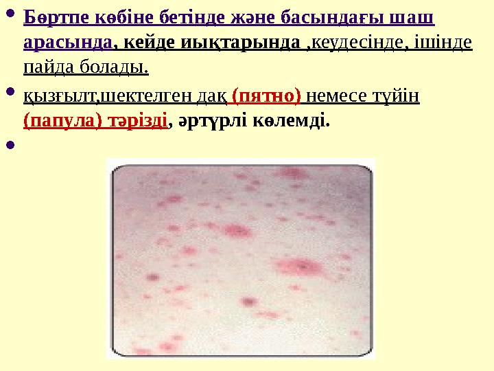  Бөртпе көбіне бетінде және басындағы шаш арасында , кейде иықтарында ,кеудесінде, ішінде пайда болады.  қызғылт,шектелген