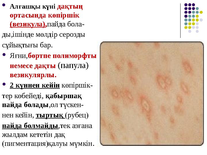  Алғашқы күні дақтың ортасында көпіршік (везикула) , пайда бола- ды,ішінде мөлдір серозды сұйықтығы бар.  Яғни, бөртпе пол