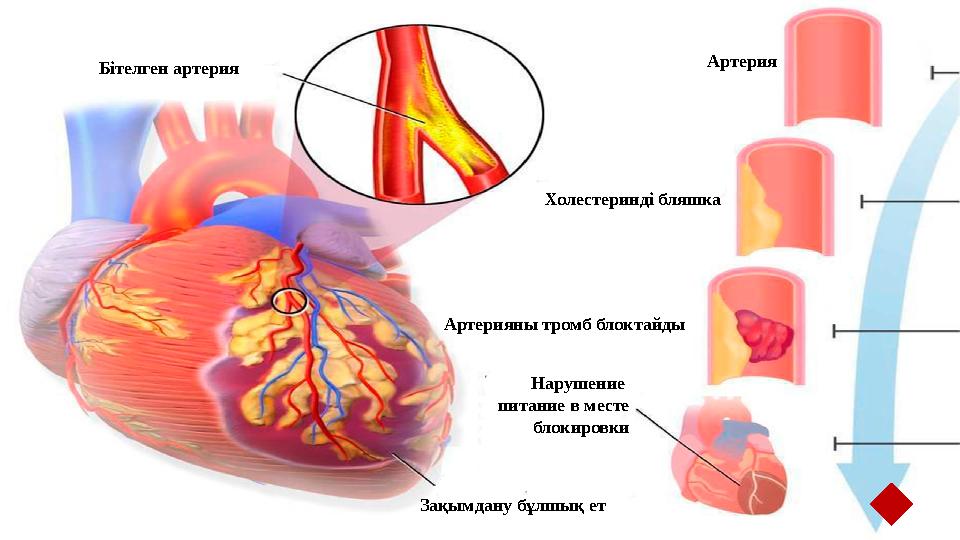 Б ітелген артерия Артерия Холестеринді бляшка А ртерия ны т ромб блоктайды Нарушение питание в месте блокировки Зақымдану