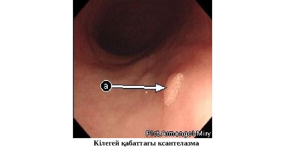 Кілегей қабаттағы ксантелазма