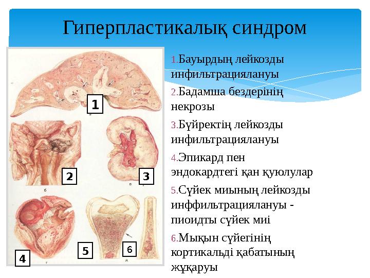 Гиперпластикалық синдром 1. Бауырдың лейкозды инфильтрациялануы 2. Бадамша бездерінің н екрозы 3. Бүйректің лейкозды инфил