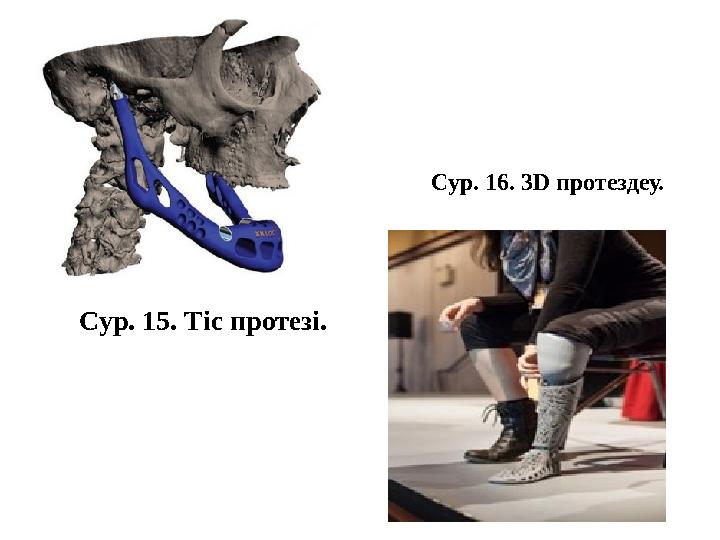 Сур. 15. Тіс протезі. Сур. 16. 3 D протездеу.