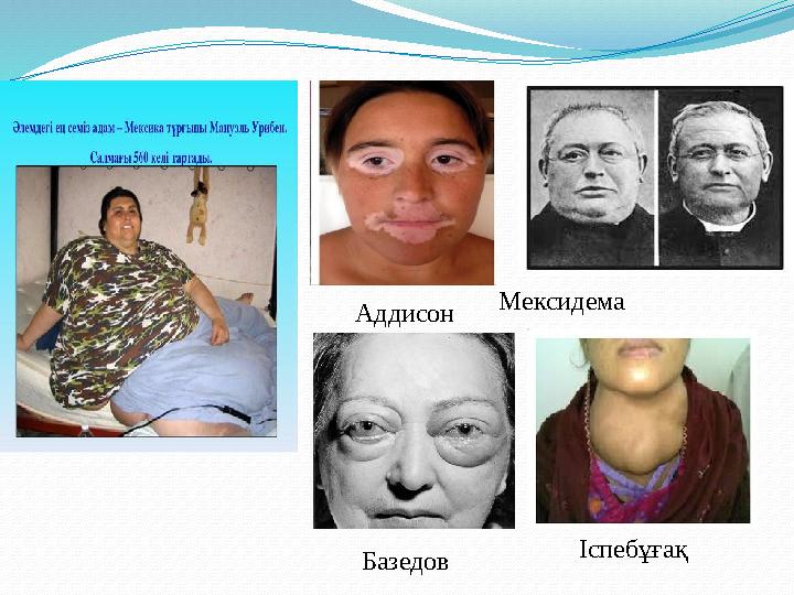 Базедов ІспебұғақМексидема Аддисон