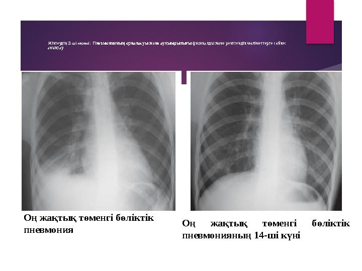 Жіктеудің 3 -ші кезеңі: Пневмонияның орналасуы және ауқымдылығы физикалды және рентгендік мәліметтерге сәйкес анықтау Оң жа