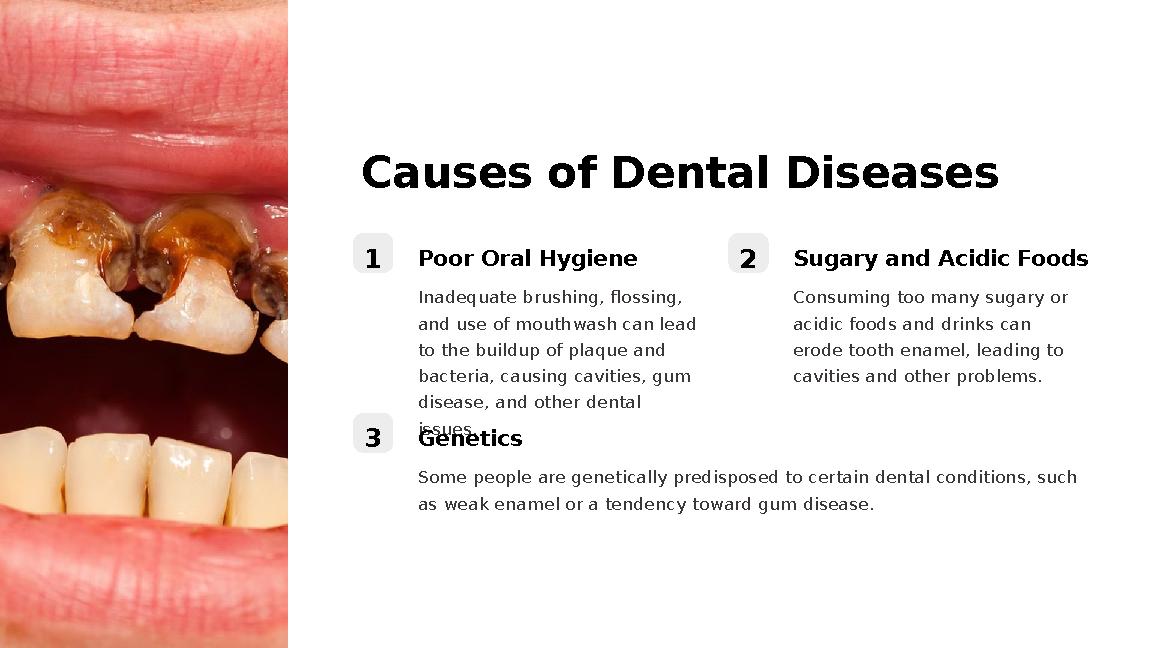 Causes of Dental Diseases 1 Poor Oral Hygiene Inadequate brushing, flossing, and use of mouthwash can lead to the buildup of p